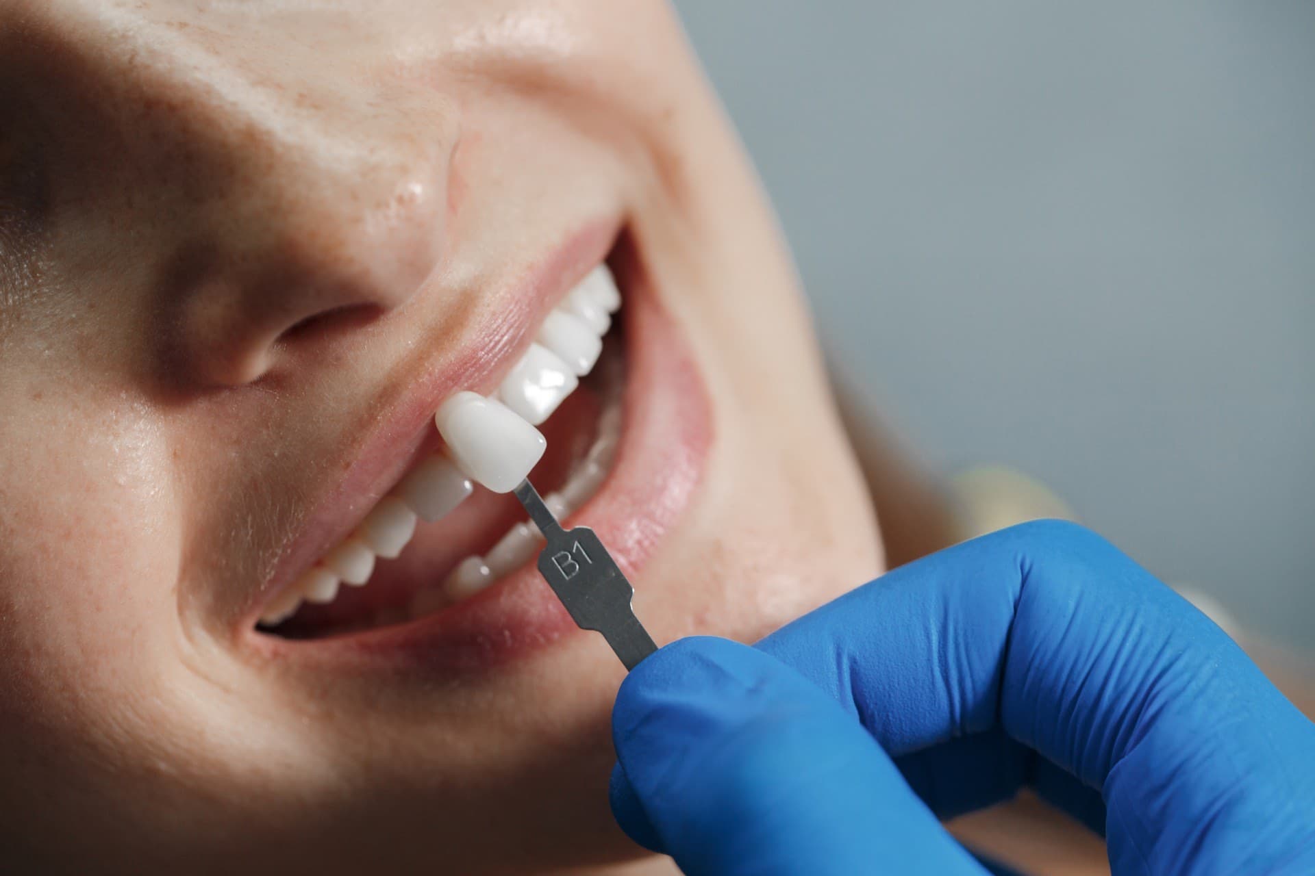 Dentist comparing a tooth shade tab with a patient's front teeth